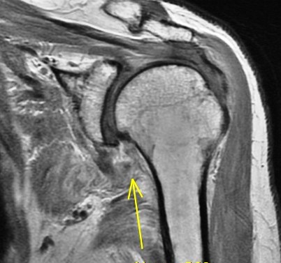 Figure 6 for case HAGL lesion and rotator cuff tears